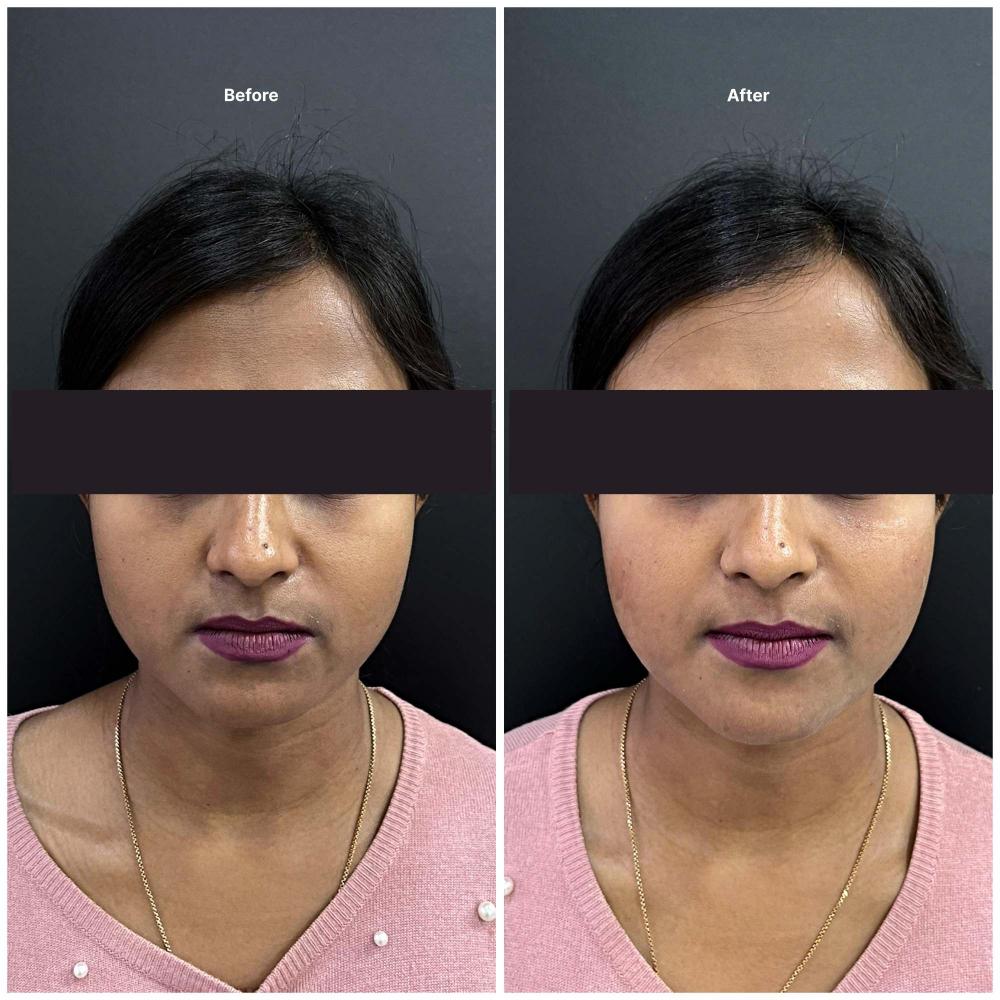Botox result KOQ10